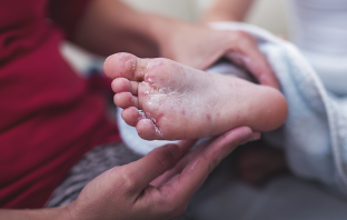 Hand, Foot And Mouth Cases On The Rise