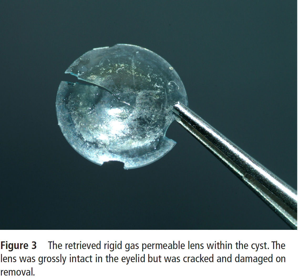 Contact Lens Found Under Eyelid 28 Years Later